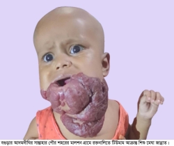 রক্তনালিতে টিউমার আক্রান্ত শিশুকে বাঁচাতে বাবা-মায়ের আকুতি 